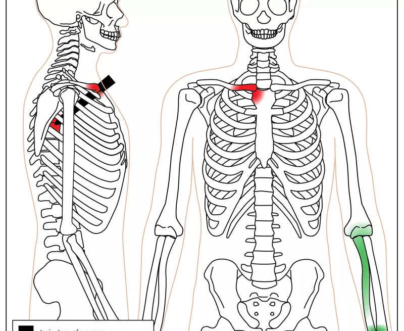 Illustration of the injuries sustained by the skeleton found at the St Michael's church, Workington